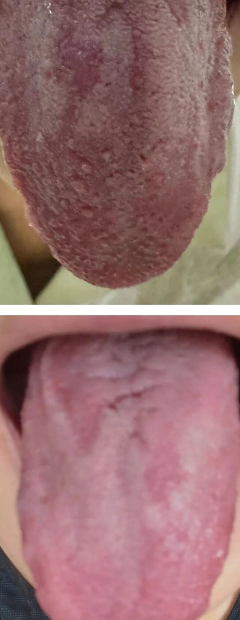 28副中药逆转霉菌性阴道炎、高危HPV82感染转阴 | 许盼盼医生典型病例实录